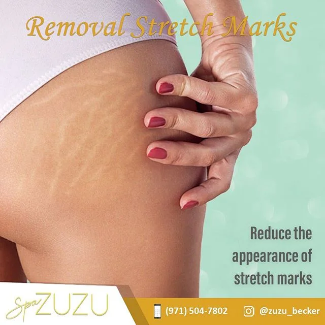 Stretch marks are tears to the connective tissue of the skin resulting in what&rsquo;s called an epidermal atrophy along the area that has been damaged. Once this happens, the epidermis becomes thin, breaking the elastic fibers and thus causing the e