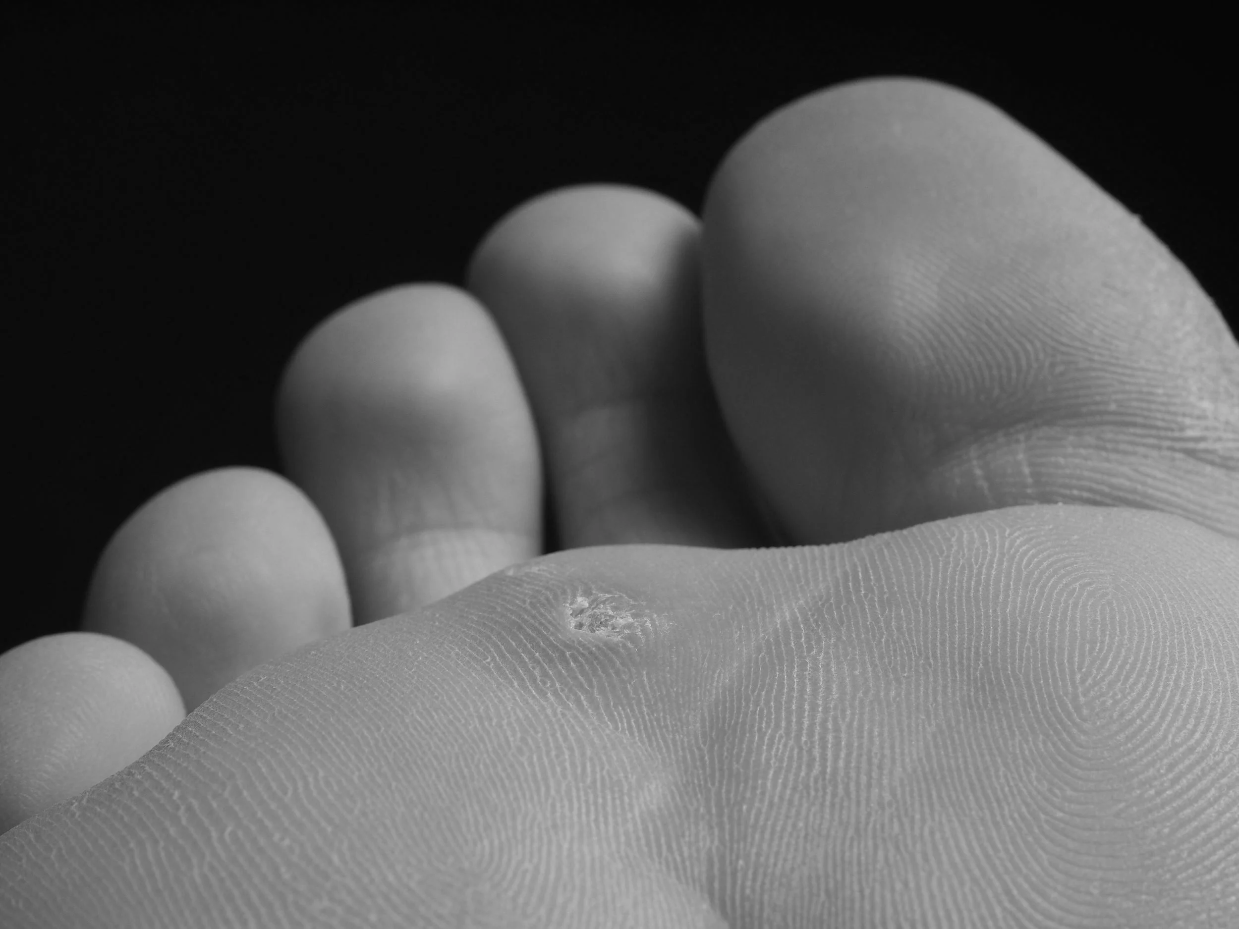 Warts