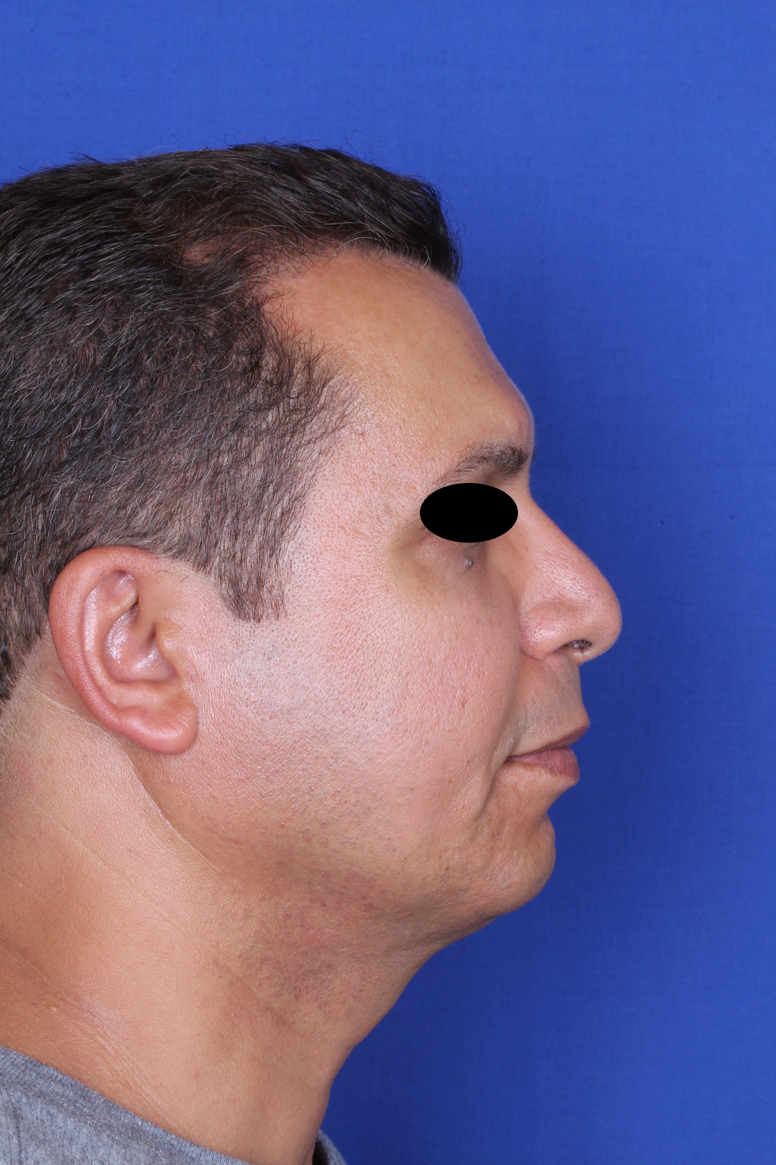 Revision rhinoplasty with chin implant