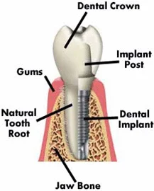 implant.jpg