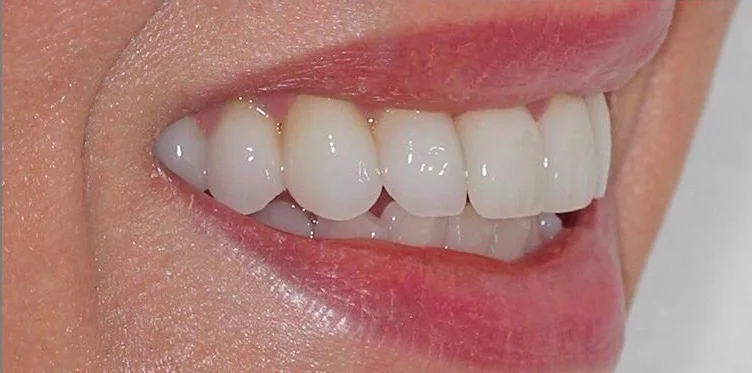 We used Digital Smile Design technology to virtually design Julie’s new smile. Through an advanced 3d printing process, we were able to deliver 12 porcelain veneers that integrated beautifully with Julie’s face.