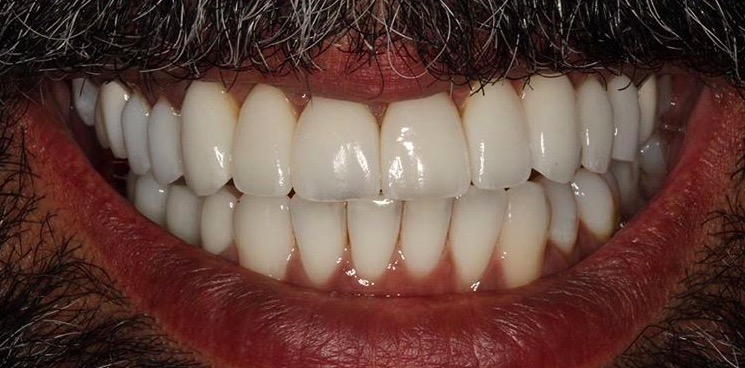 We corrected Jason’s smile with 12 porcelain veneers, custom-fabricated using feldspathic porcelain.