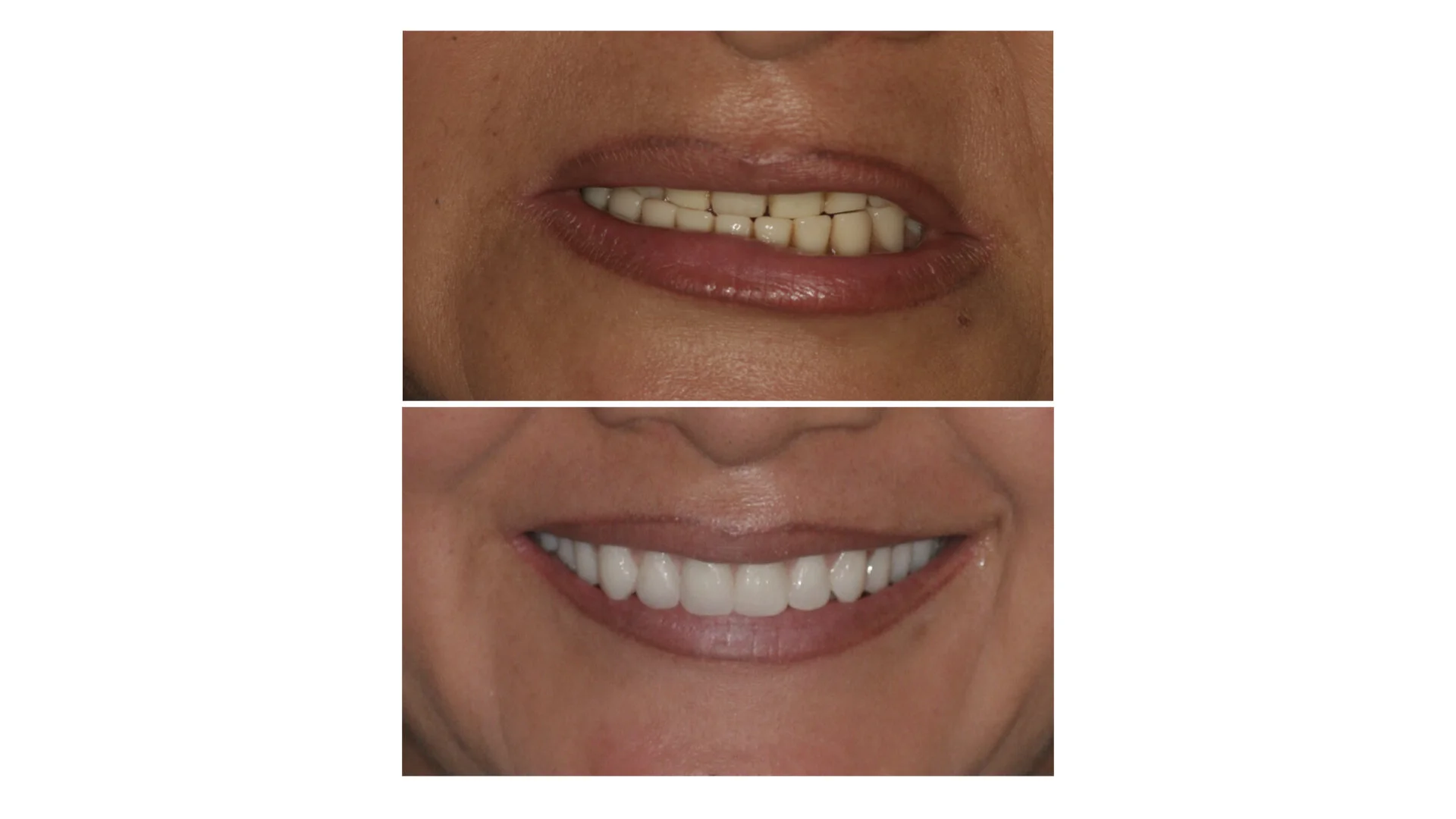 Your All-Inclusive Guide to Getting New Dentures