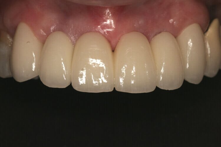 dentalimplants10.jpg