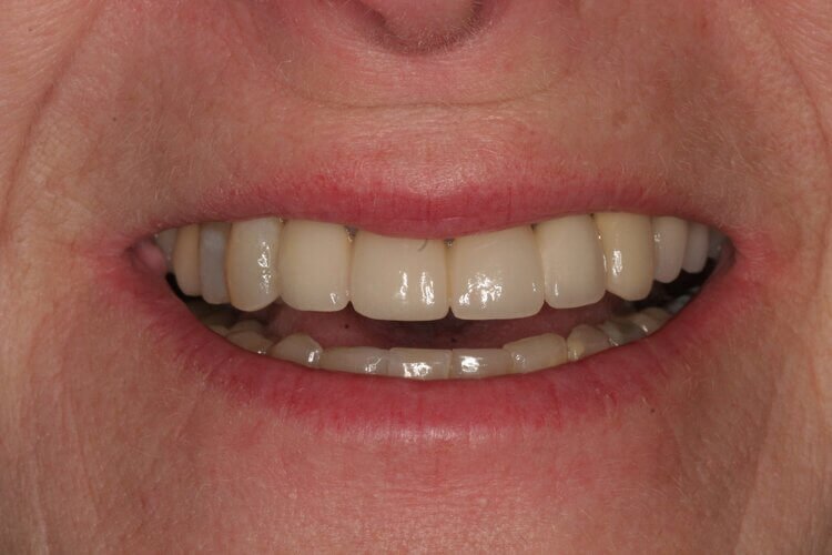 dentalimplants11.jpg