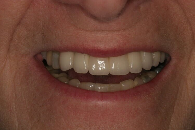 dentalimplants12.jpg