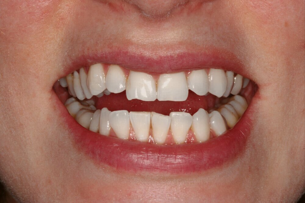 Invisalign After Braces in NYC - Cosmetic, General and Pediatric Dentistry  located in the heart of NYC.