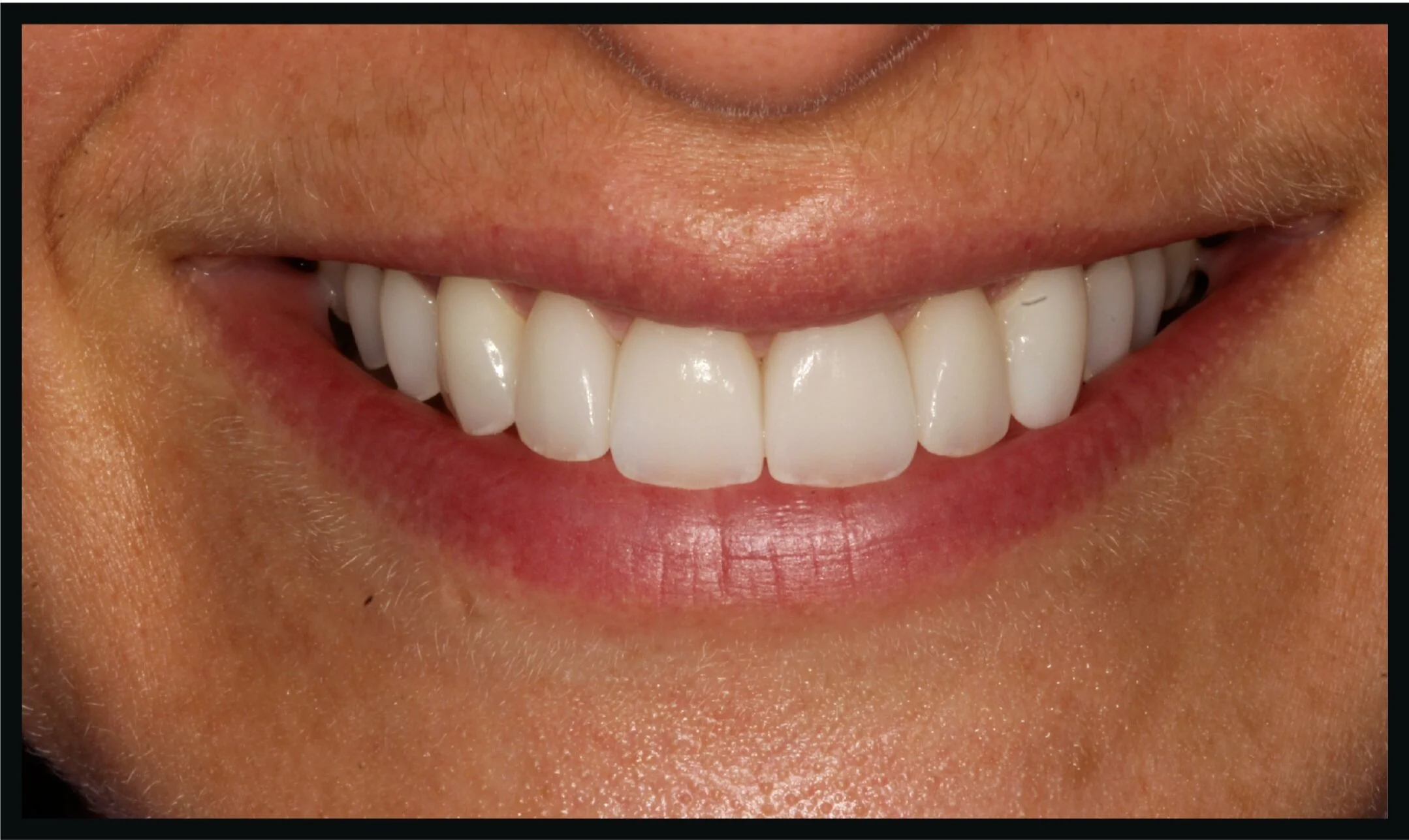 Porcelain Veneers:  Are They Right for You?