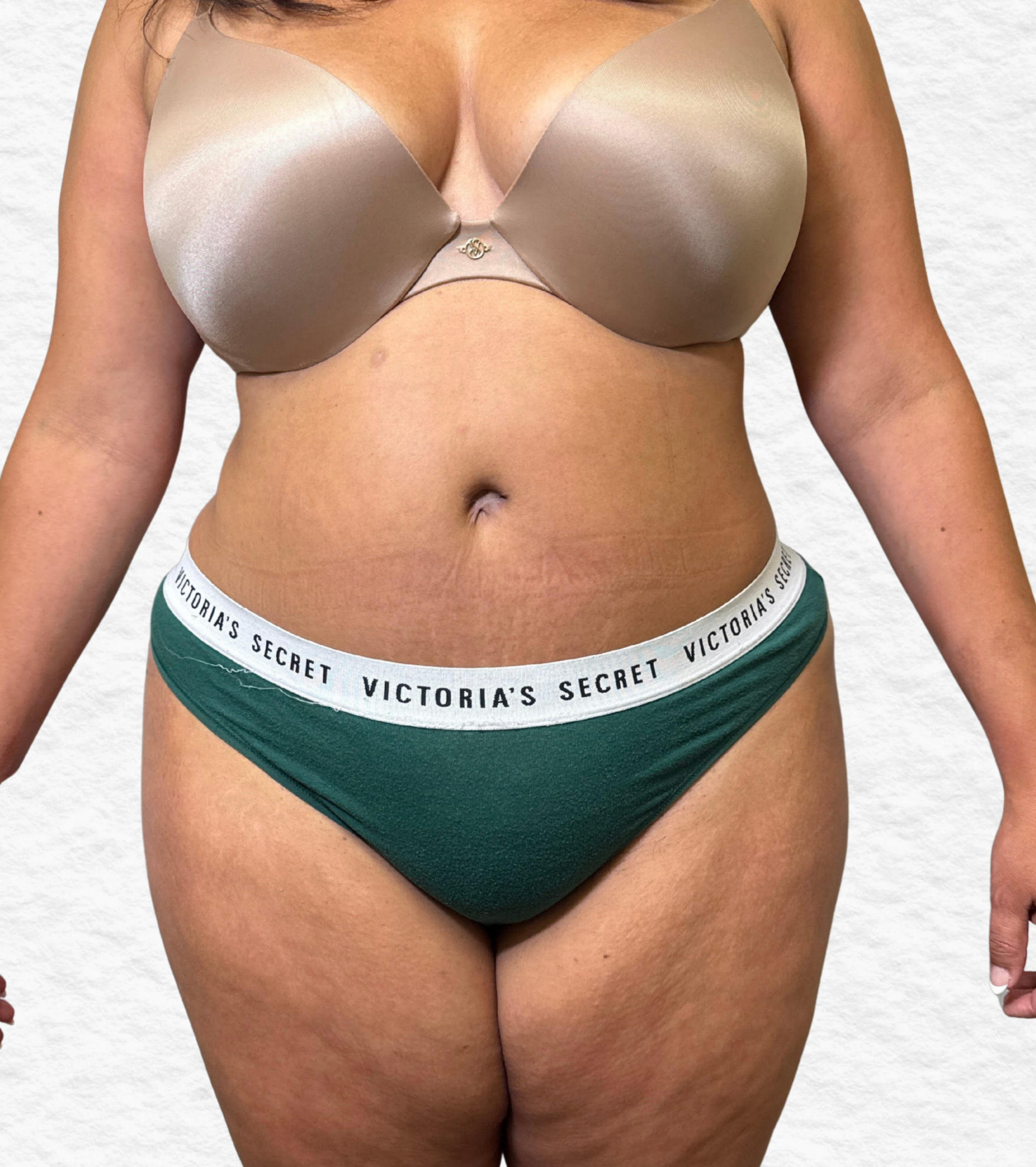 After Tulua tummy tuck front view with a flatter abdomen, improved waist contour, and restored abdominal tightness following surgery.