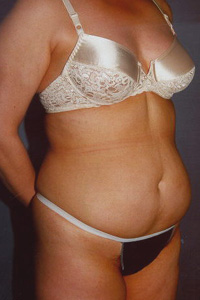 A-Lipo-Front-B.jpg