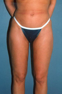 B-Lipo-Front-A.jpg