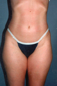 C-Lipo-Front-B.jpg