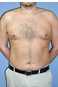 D-Lipo-Front-B.jpg