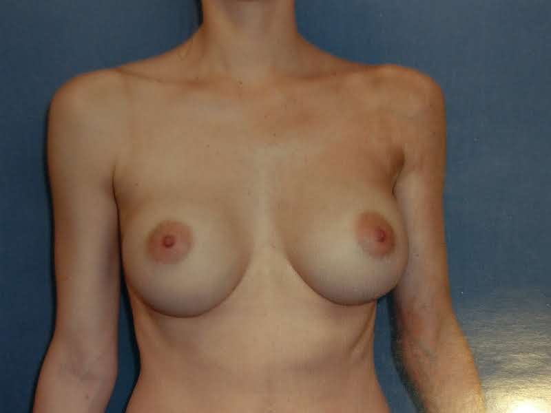 A Before (Submuscular smooth gel).jpg