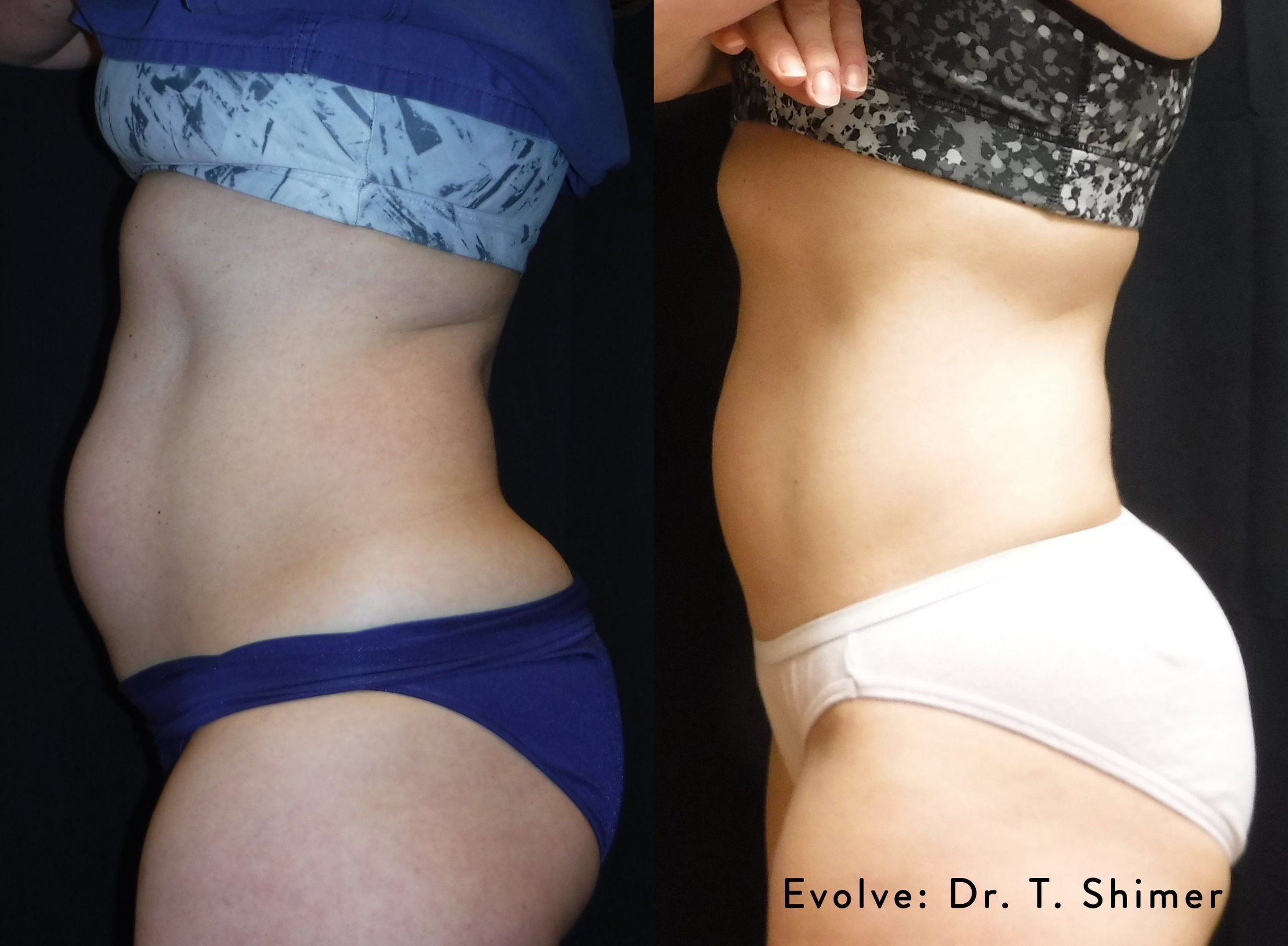 evolve-before-after-dr-t-shimer-preview-1.jpg