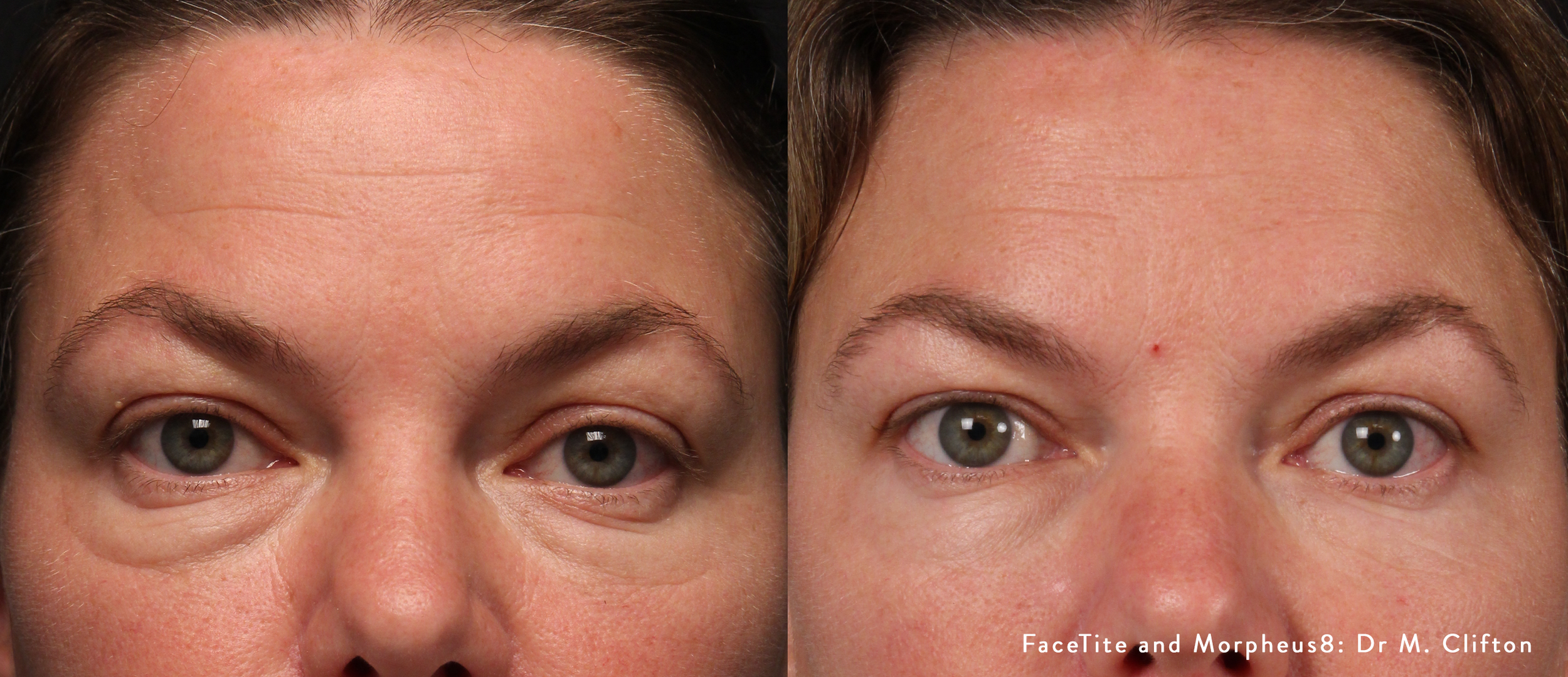 facetite-and-morpheus8-before-after-dr-m-clifton-preview-1.png