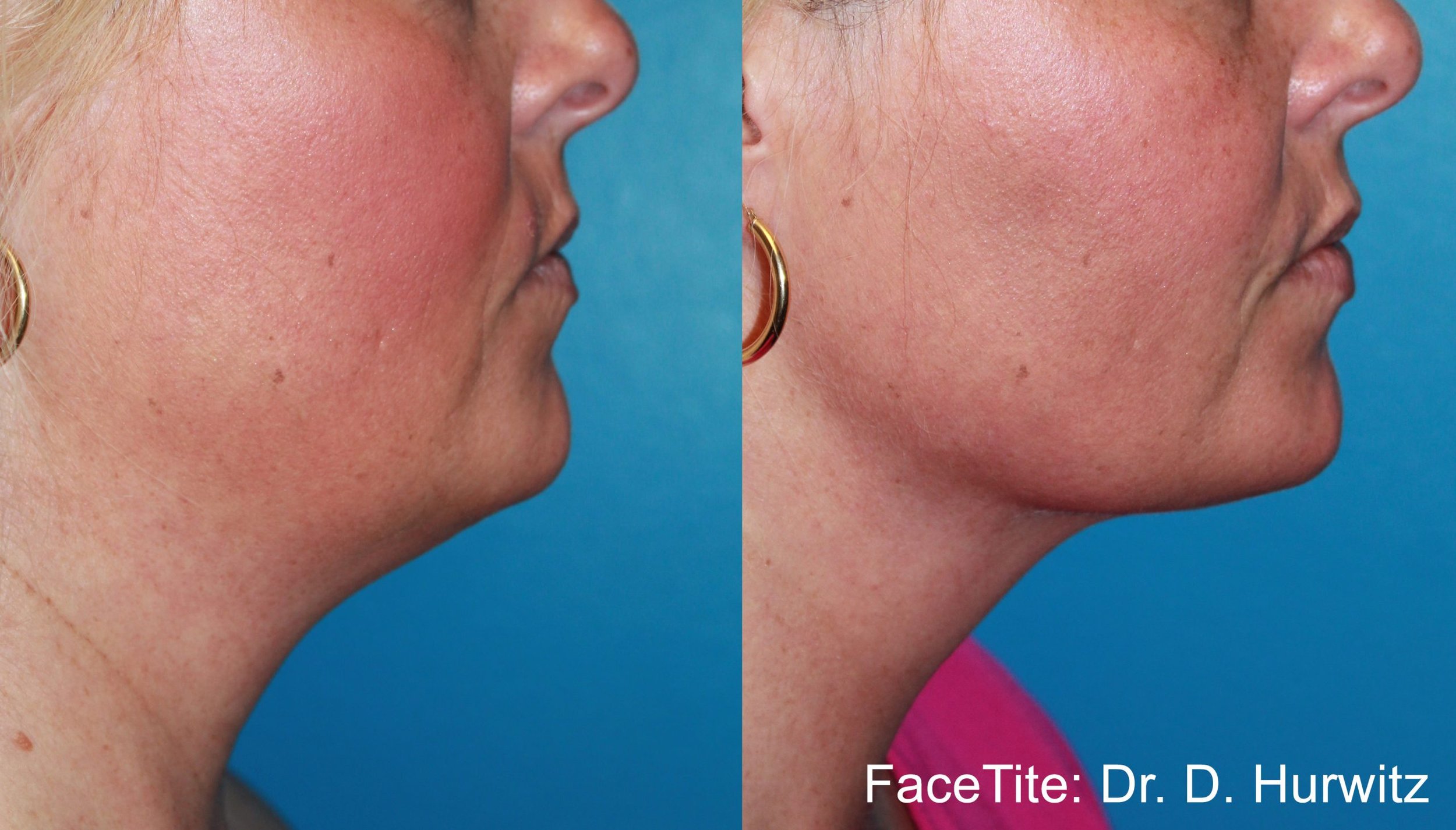 facetite-before-after-dr-d-hurwitz-preview-1.jpg