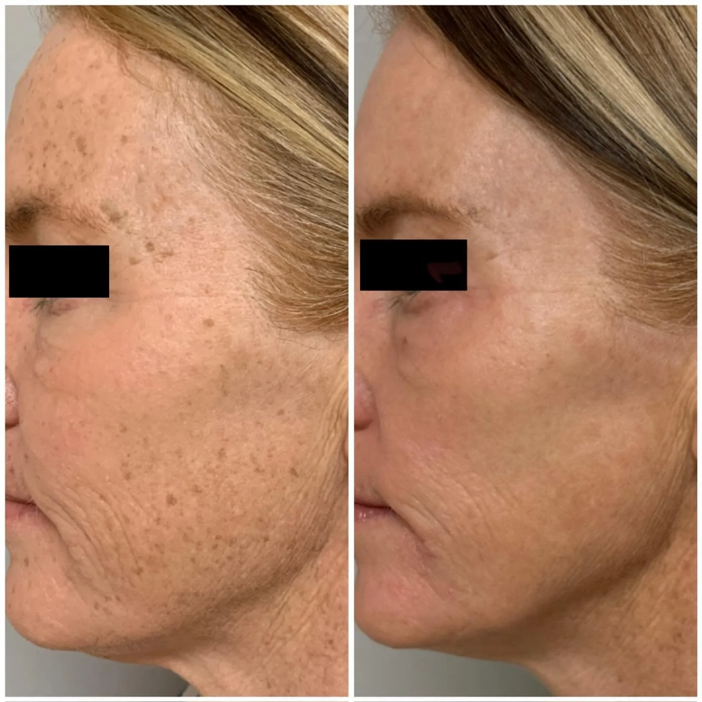 Side-by-side comparison of a woman's face showing improved skin condition; before and after skin treatment, highlighting reduction in dark spots and smoother skin.