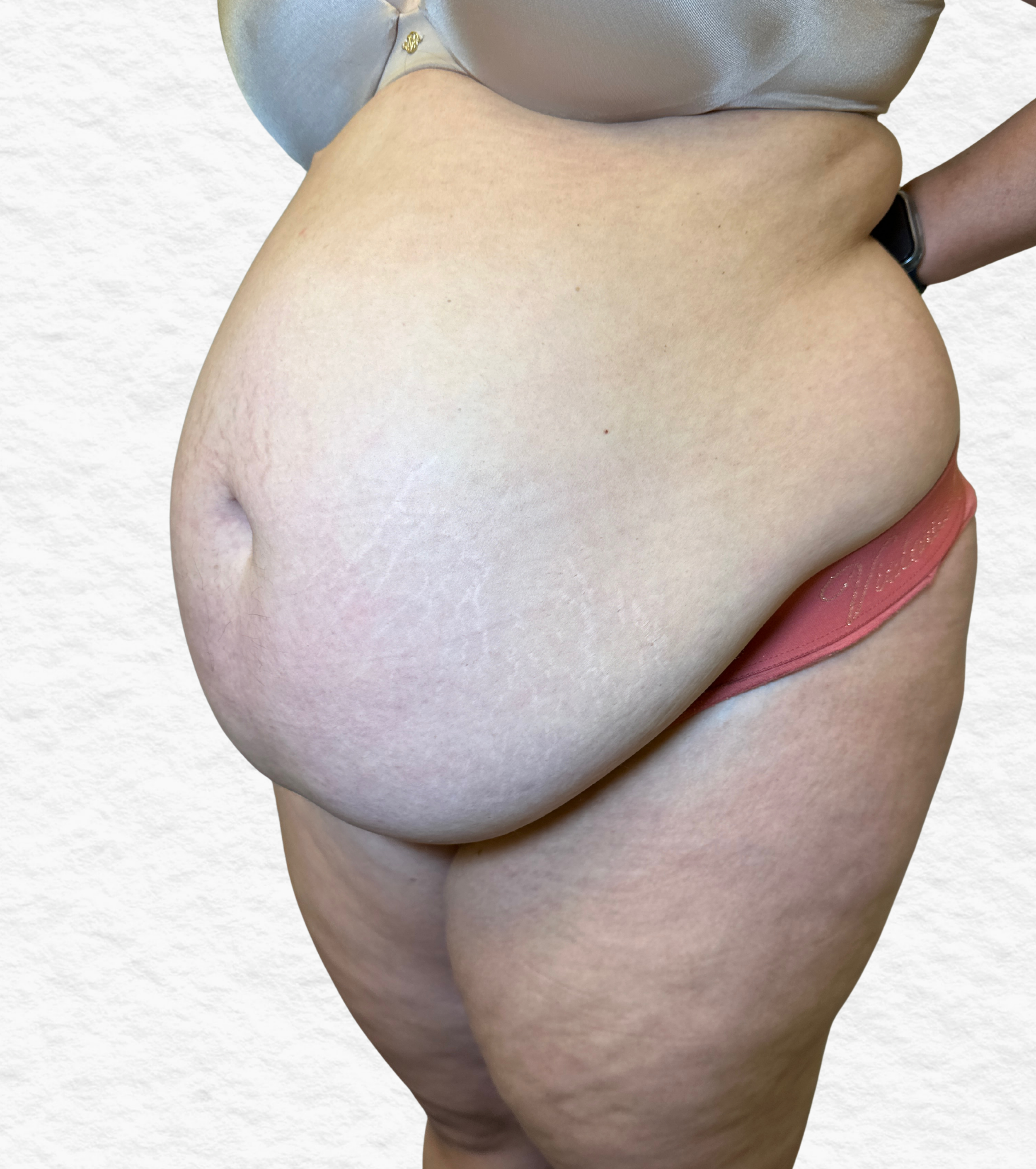 Before Tulua abdominoplasty angled view demonstrating excess lower abdominal skin, overhang, and weakened abdominal wall appearance.
