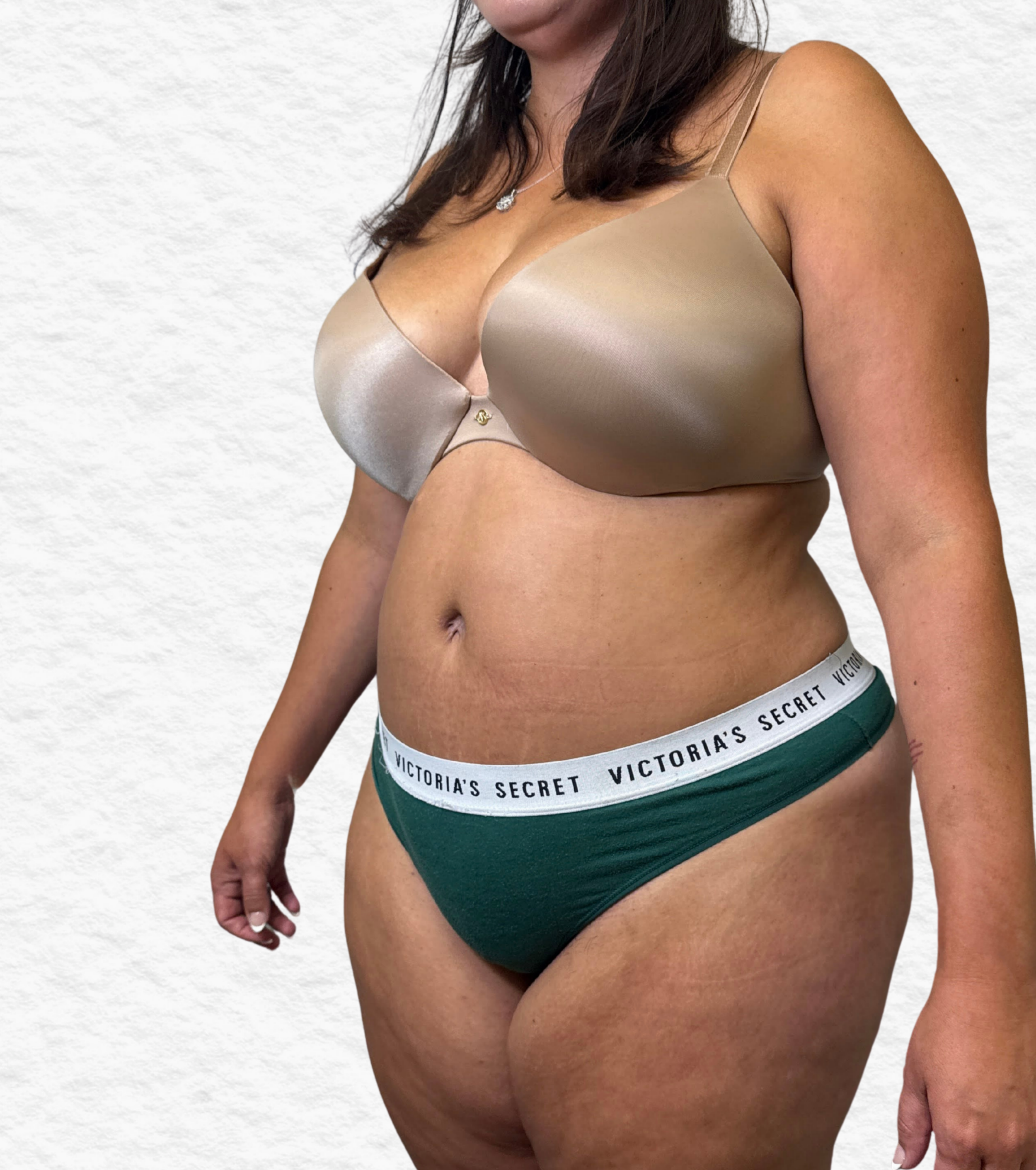 After Tulua abdominoplasty angled view showing smoother abdominal profile, reduced lower belly fullness, and enhanced overall contour.