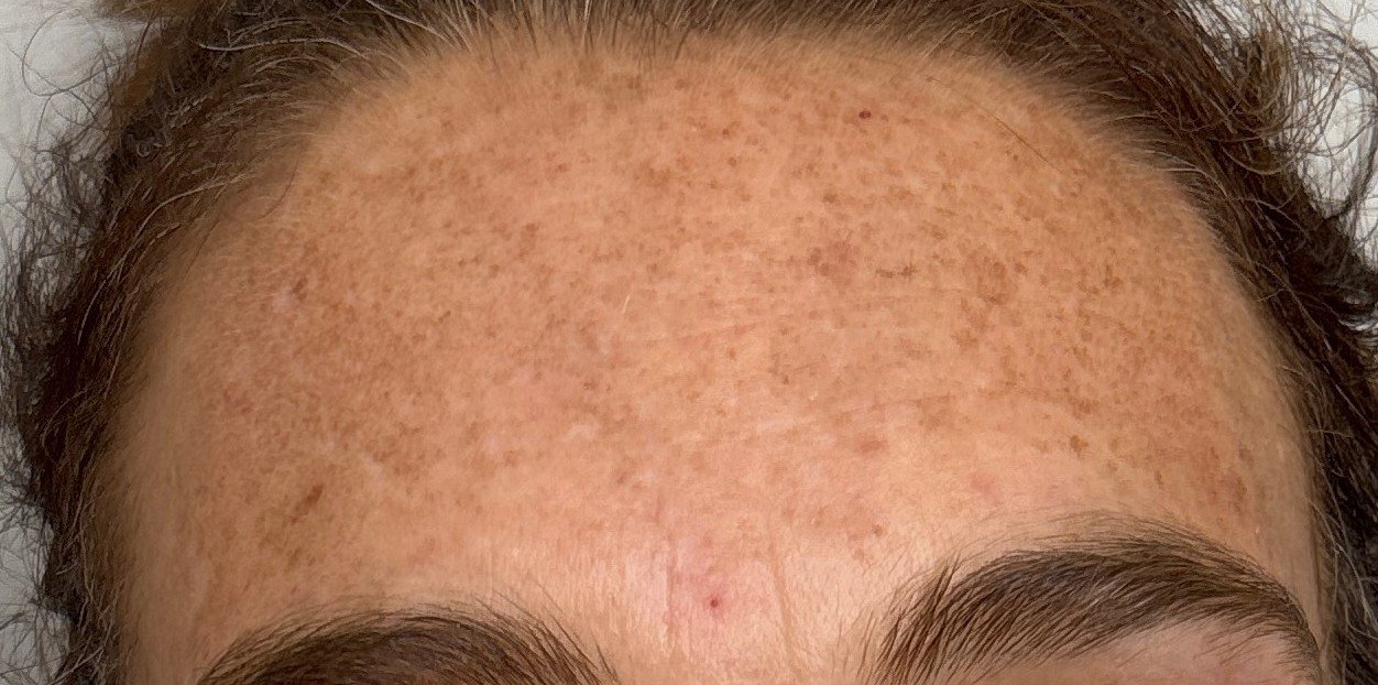 Close-up of a person's forehead showing freckles and skin texture.