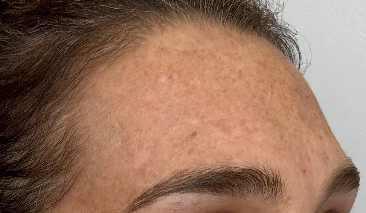 Close-up of a person's forehead showing freckles and skin texture.