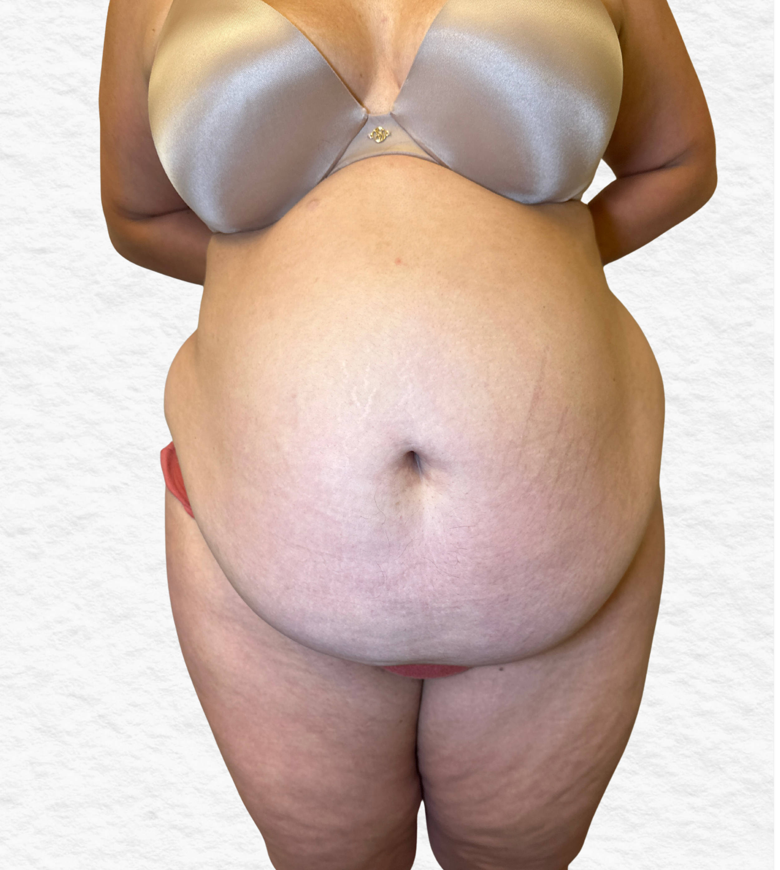 Before Tulua tummy tuck front view showing abdominal skin laxity, central fullness, and separation of abdominal contour prior to surgery.