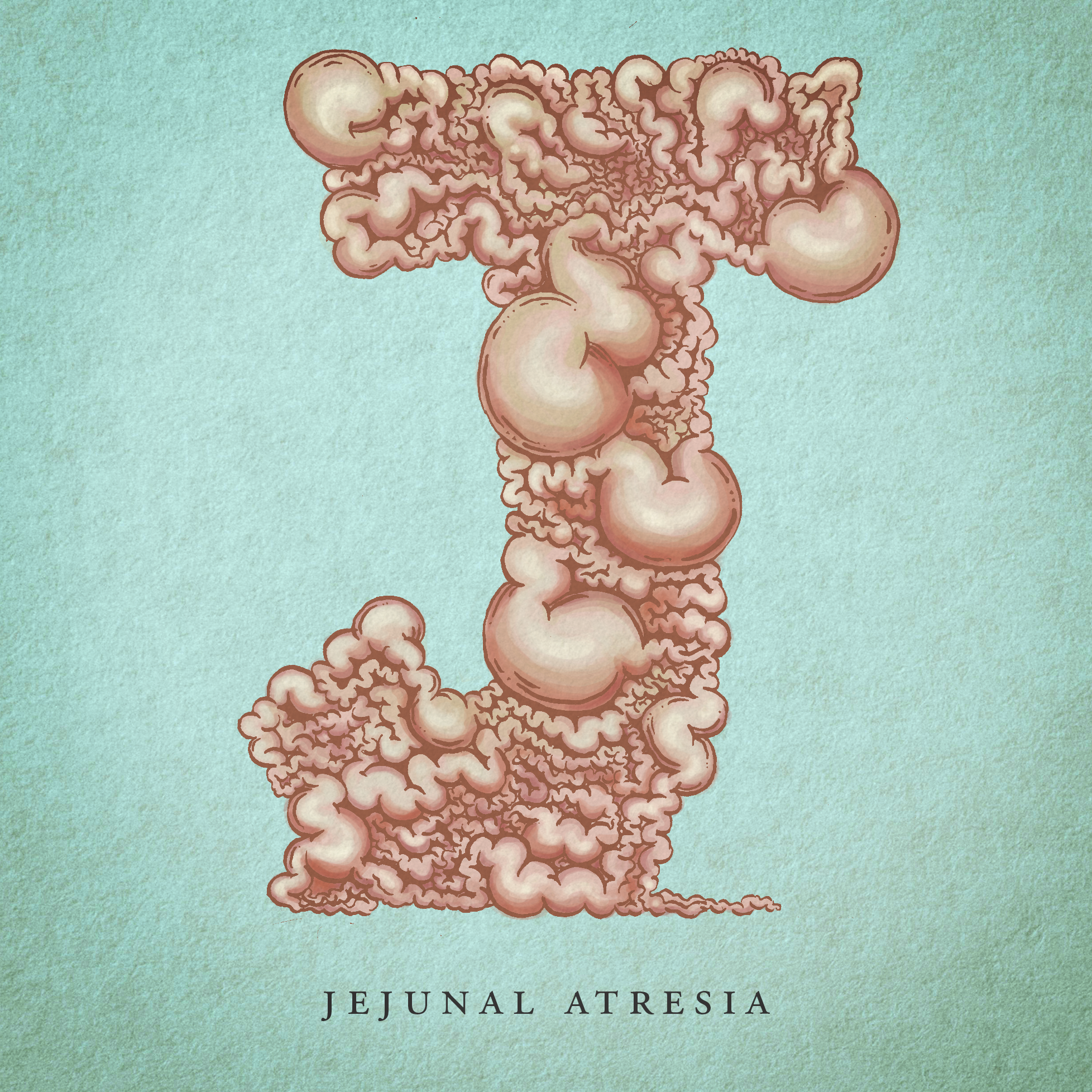Jejunal Atresia.png