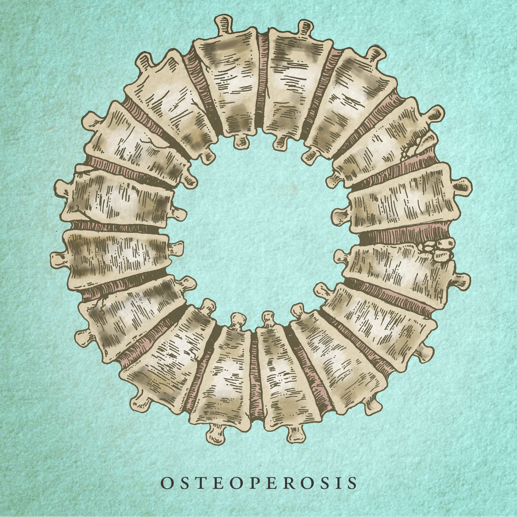 Osteoperosis.png