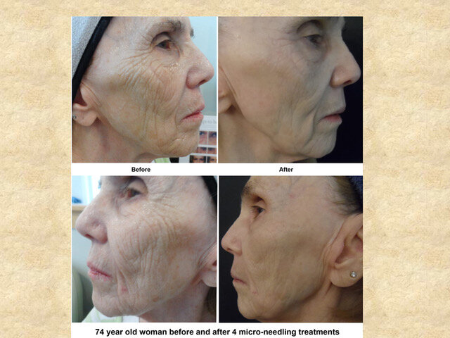 010ProCellBeforeAndAfter-1-05.jpeg