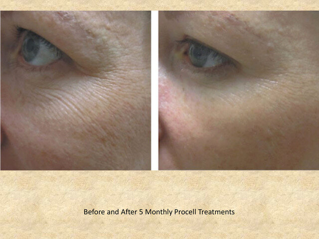 010ProCellBeforeAndAfter-1-03-1.jpeg