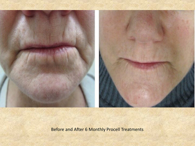 010ProCellBeforeAndAfter-1-04.jpeg