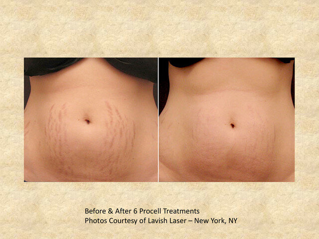 010ProCellBeforeAndAfter-1-11.jpeg
