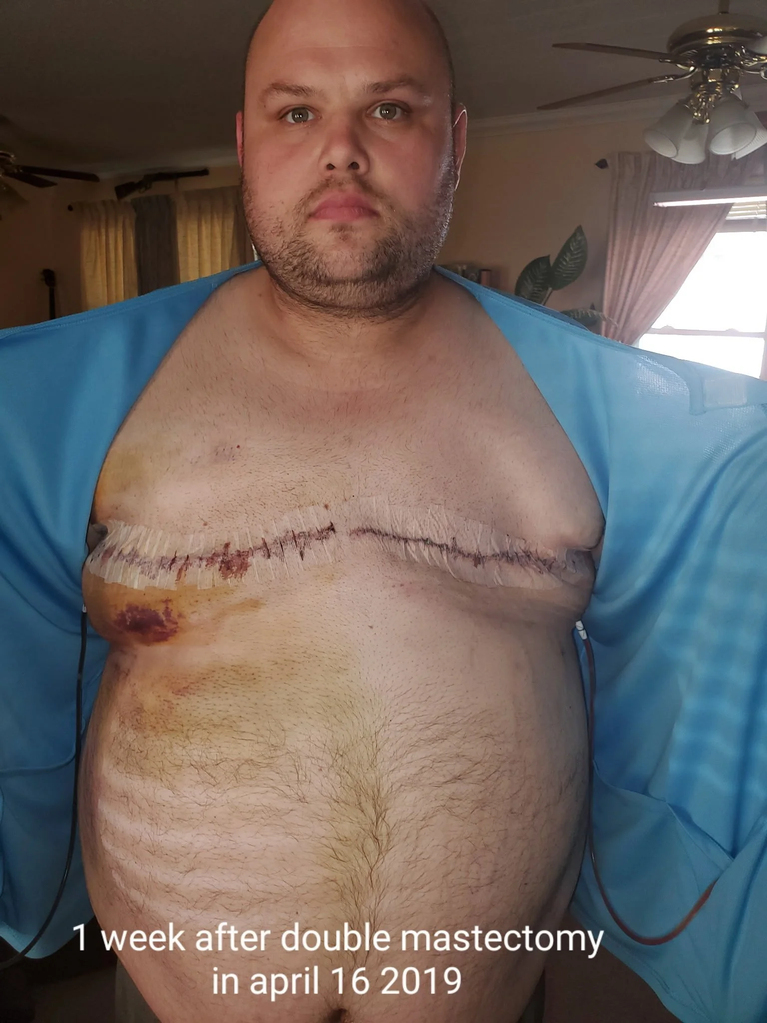 Jeremy Bailey after double mastectomy