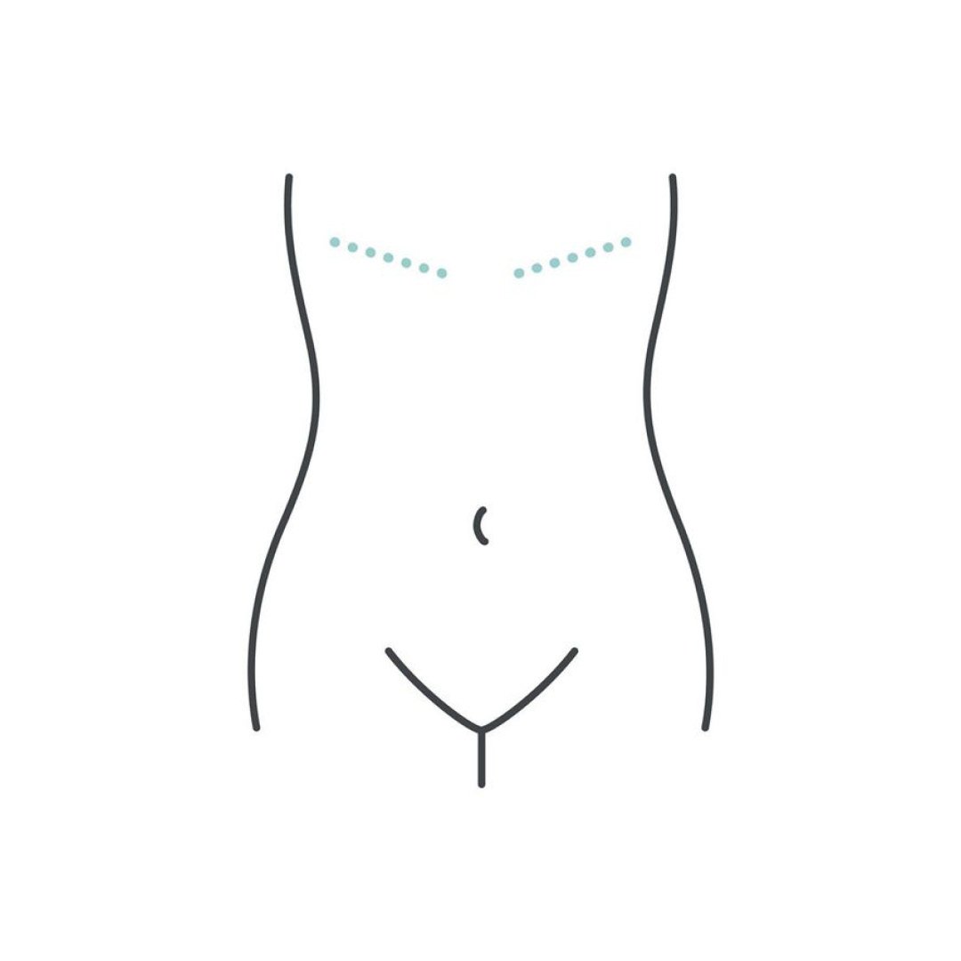 Keep A Breast Foundation - #Aestheticflatclosure is an approach to  mastectomy when breast reconstruction is not being performed. The goal in  this type of surgery is to have a chest contour be