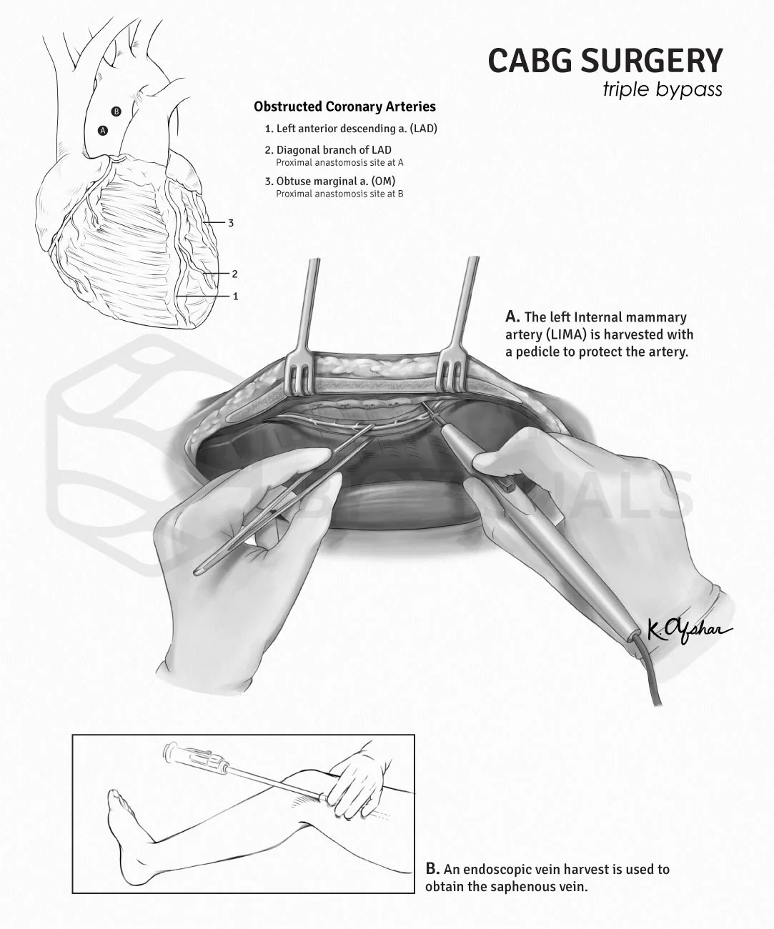 Coronary Artery Bypass Graft