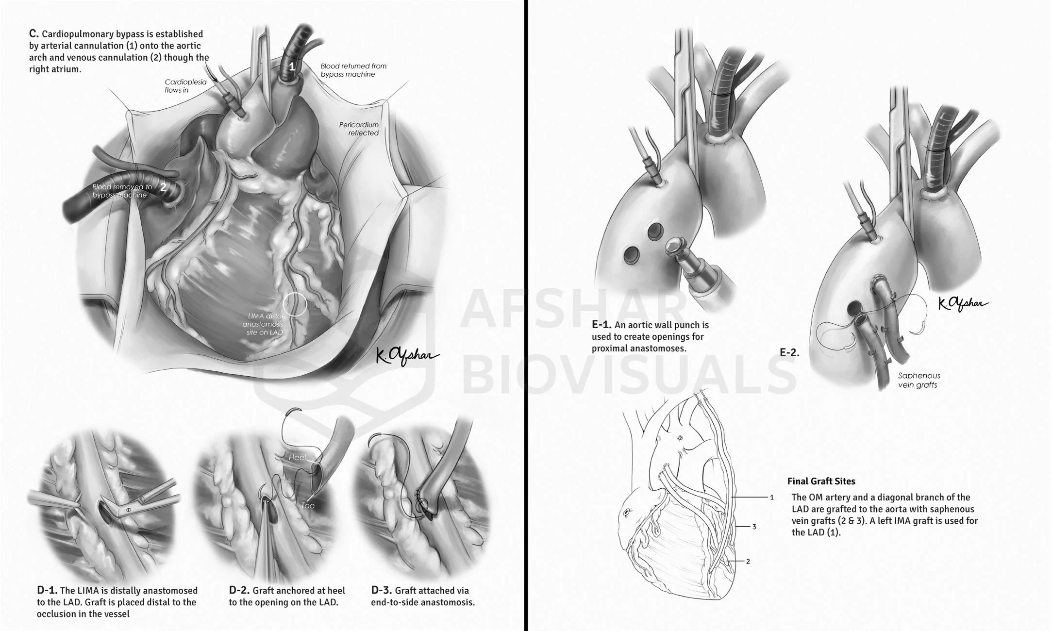 Cabg_23_wm.jpg