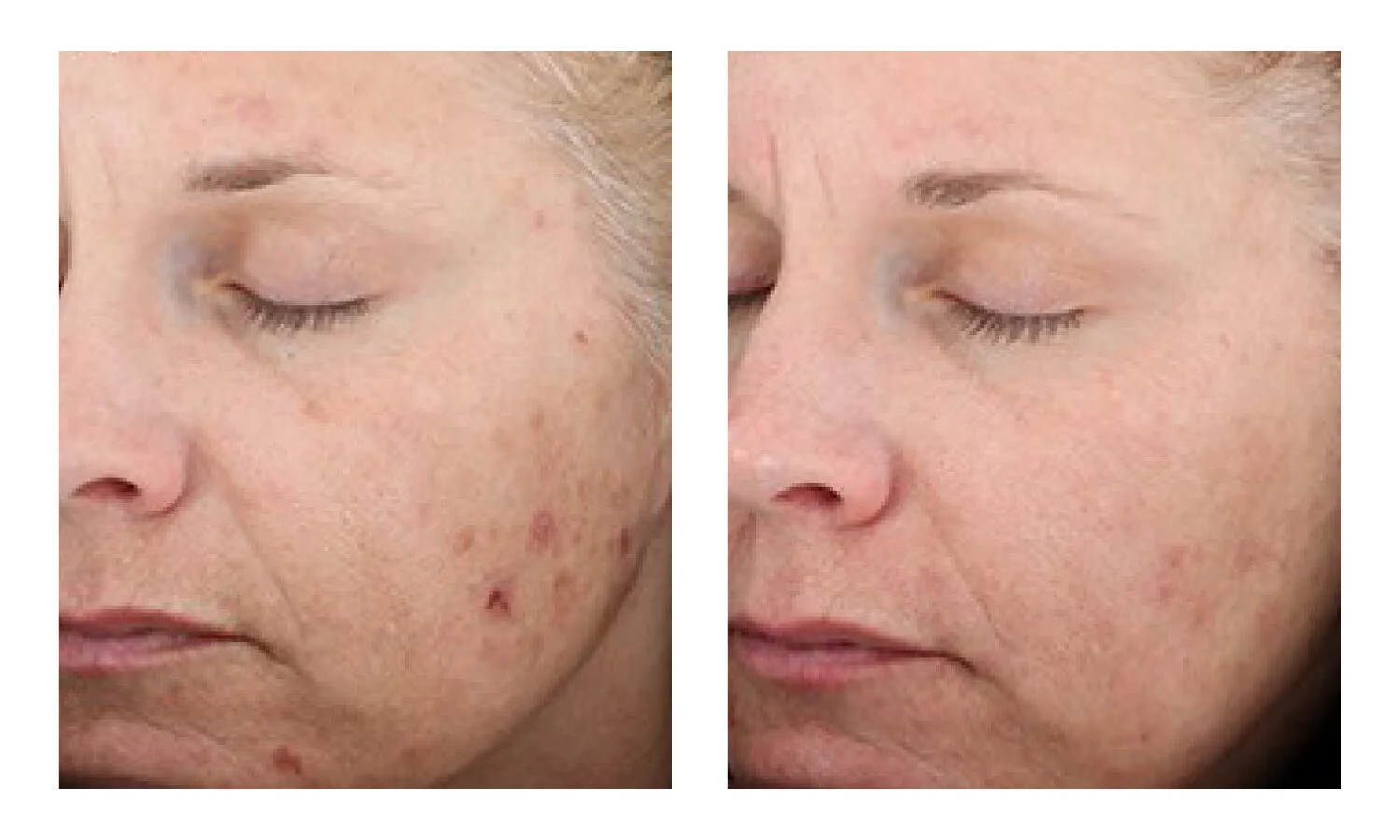 vitalize peel