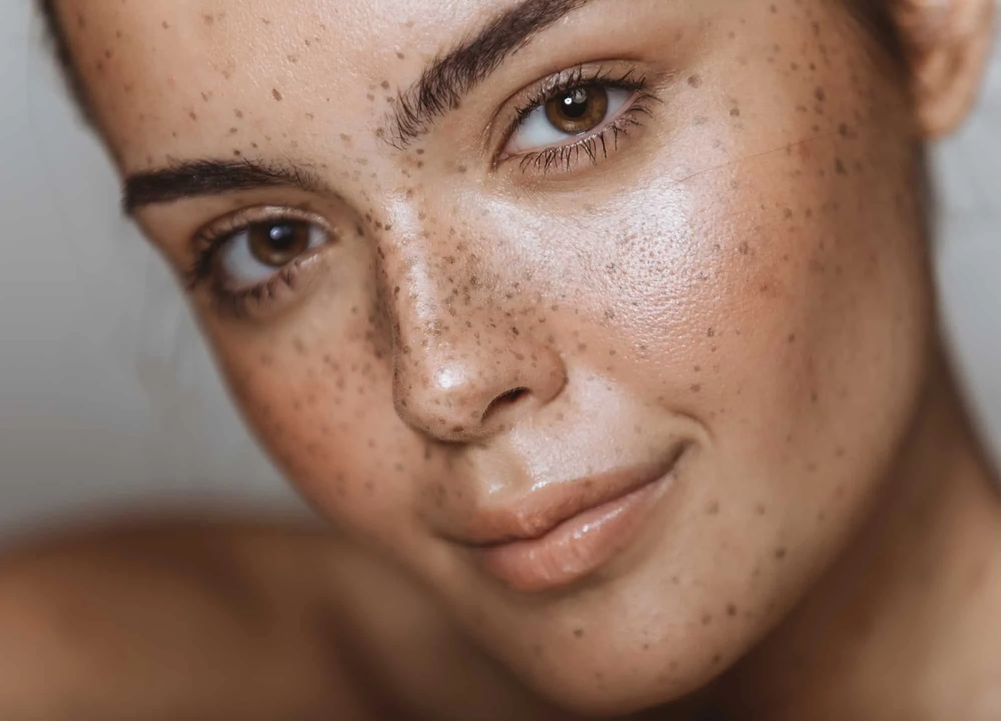 Areas of Concern: Hyperpigmentation and How to Treat It — M Spa at the