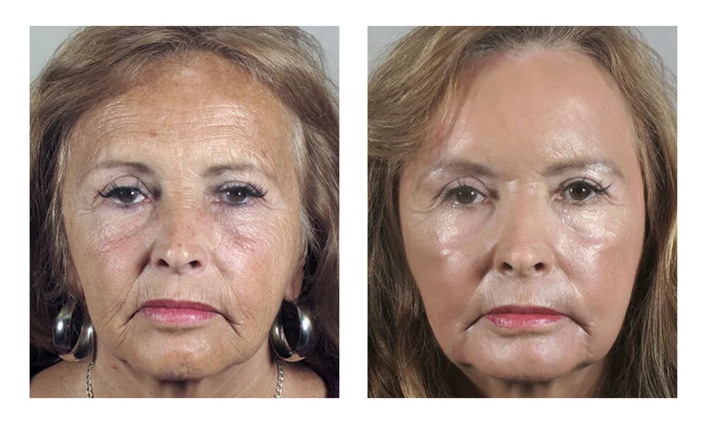 vitalize peel near me