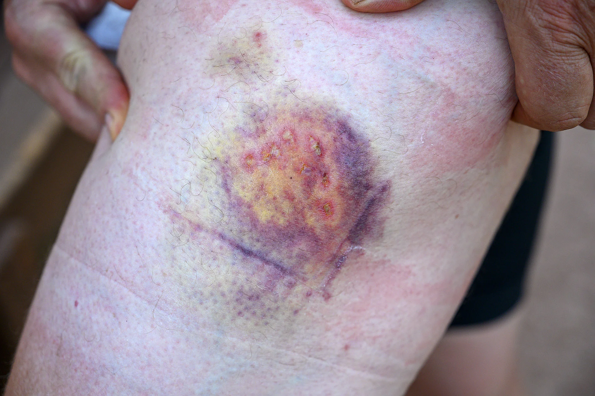 Colorful Stage of Dog Bite