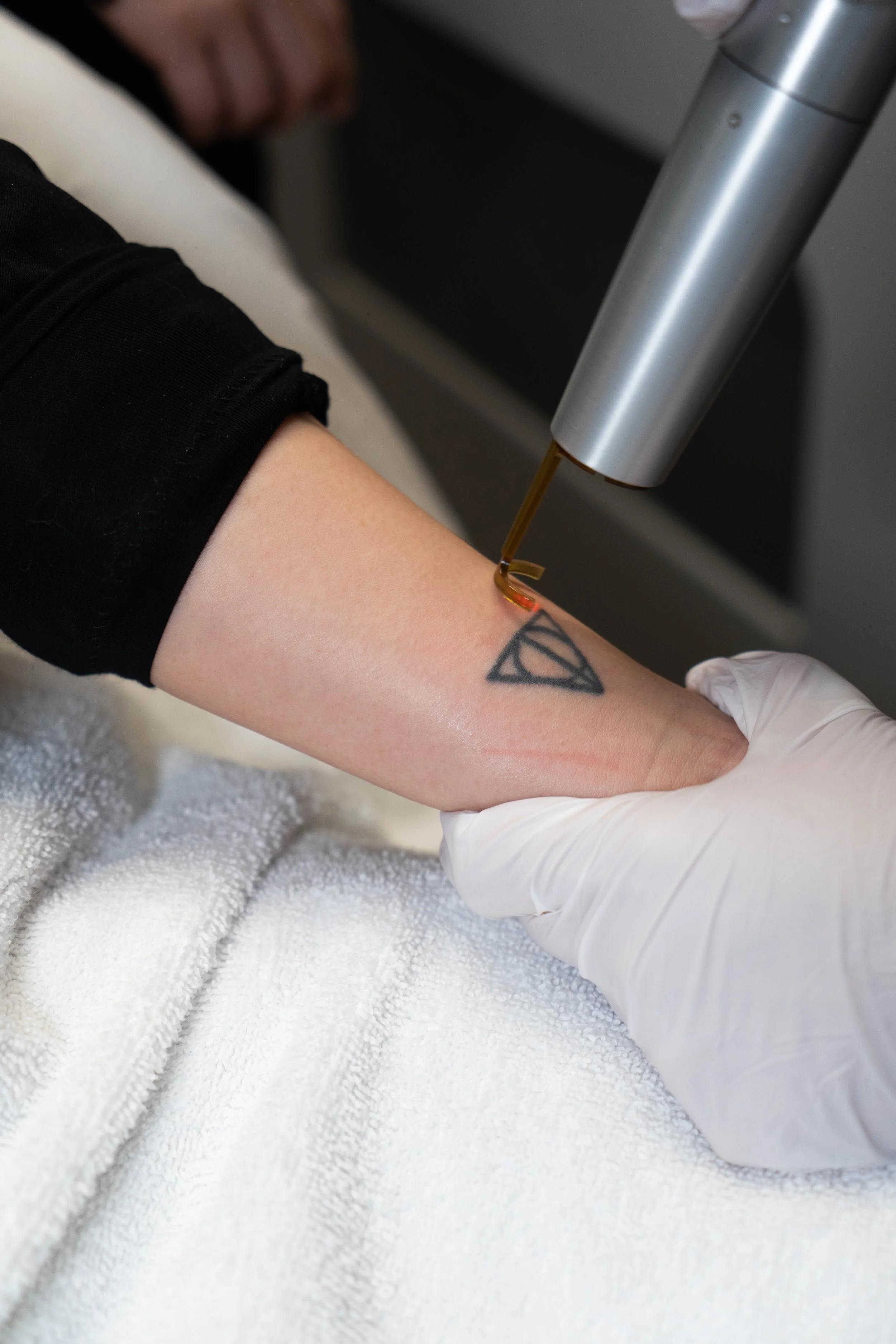 tattoo removal (3 of 4).jpg