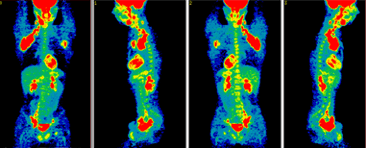PET scans. Uptake of tracer in the lymph nodes involved with lymphoma in the groin, both axilla, and neck (red areas). Image courtesy of Dr. Jorge Carrasquillo, Nuclear Medicine Department, Clinical Center, National Institutes of Health