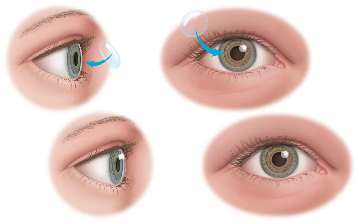 Illustration of Corneal Transplants · Dr Brendan Cronin · Brisbane Ophthalmologist