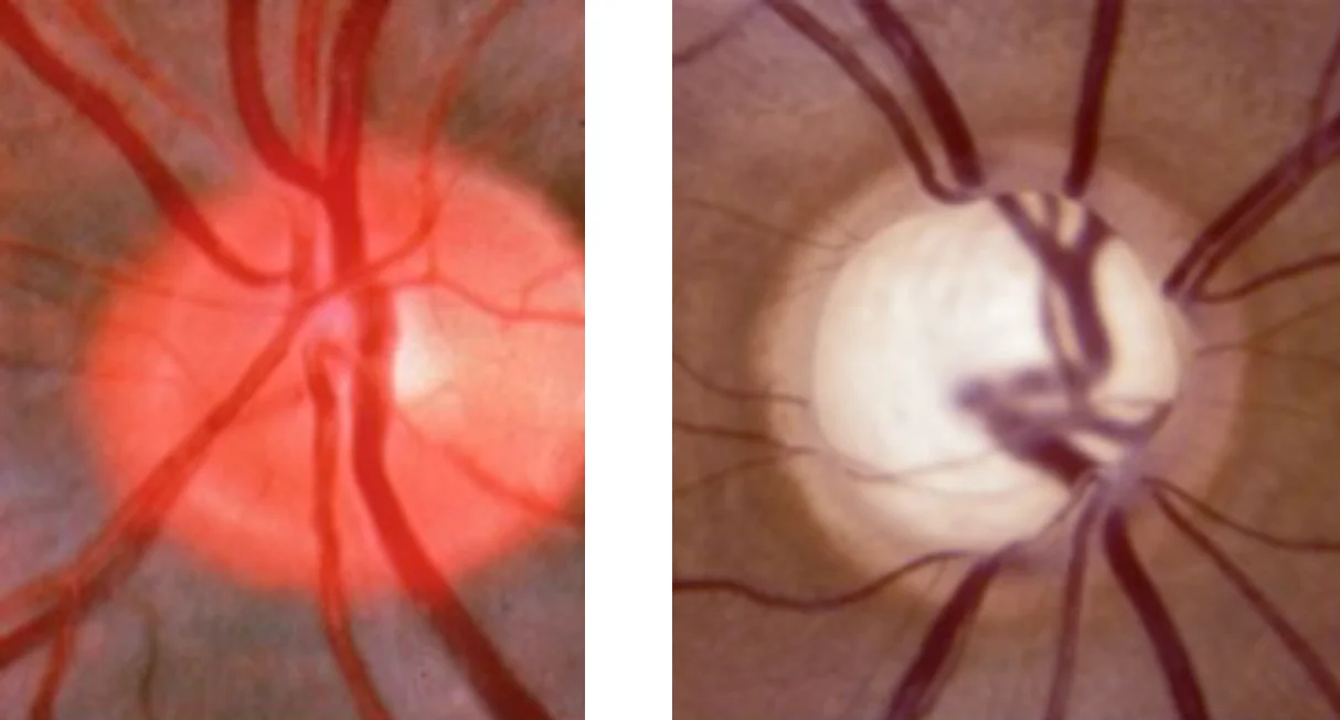 Illustration of a healthy optic nerve next to an optic nerve with Open Angle Glaucoma.