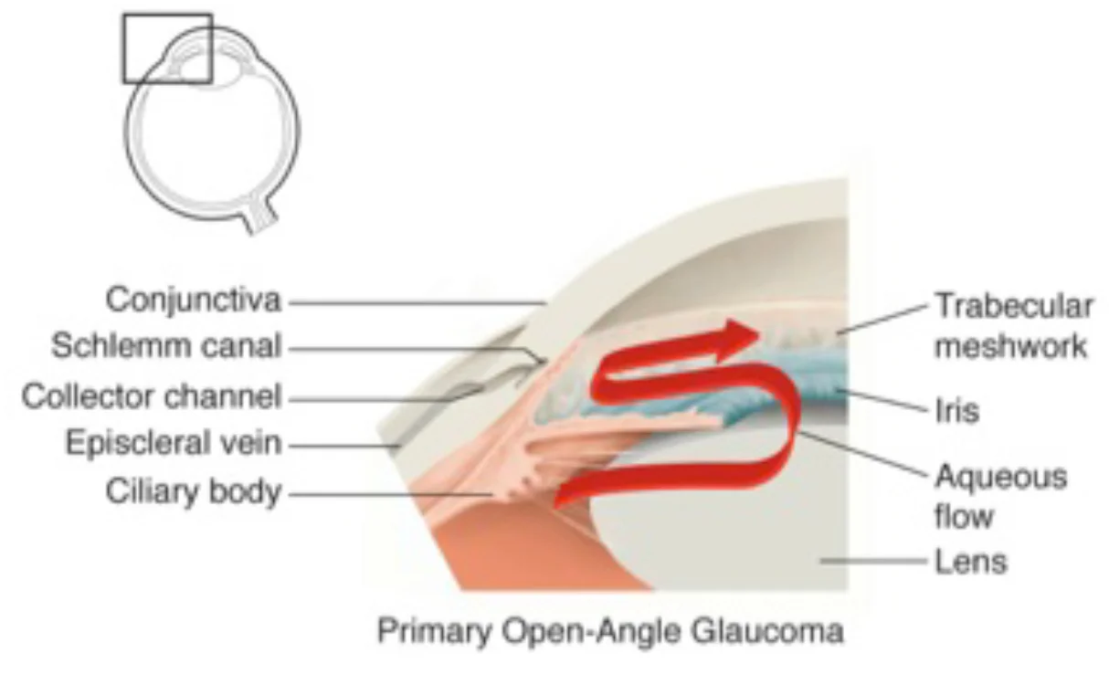 Diagram of Primary Open-Angle Glaucoma.