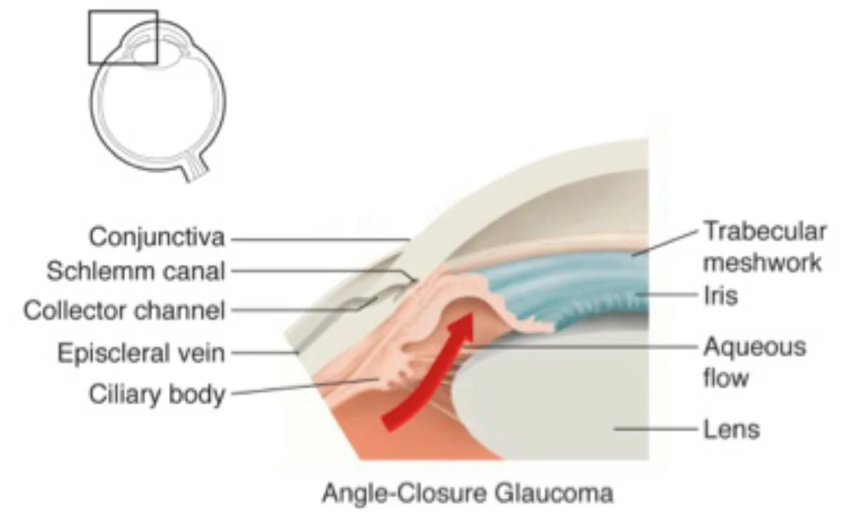 Angle Closure Glaucoma.
