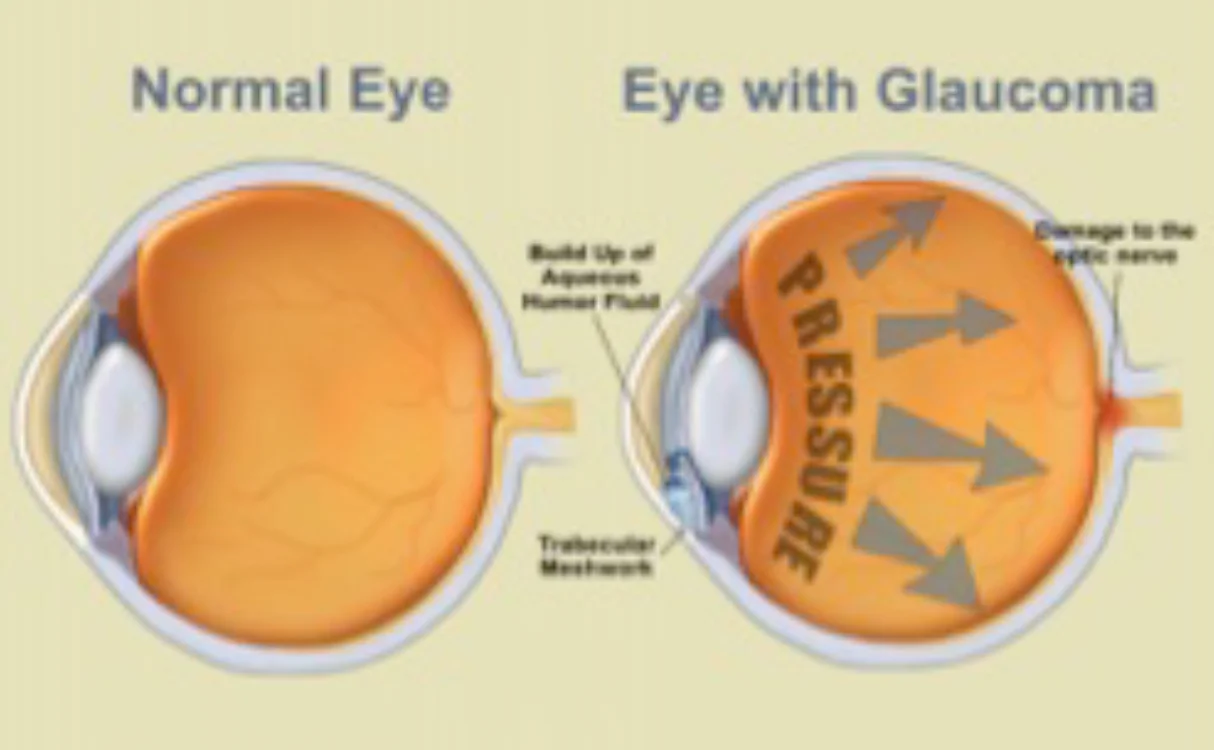 Normal Eye and Eye with Glaucoma Diagram Dr Brendan Cronin Brisbane.jpg