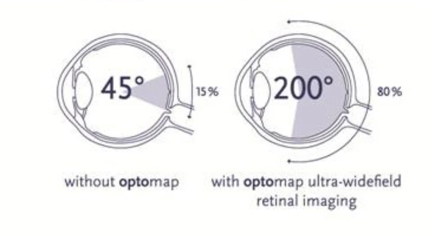 Optos Optomap retina imaging Dr Brendan Cronin, Brisbane.
