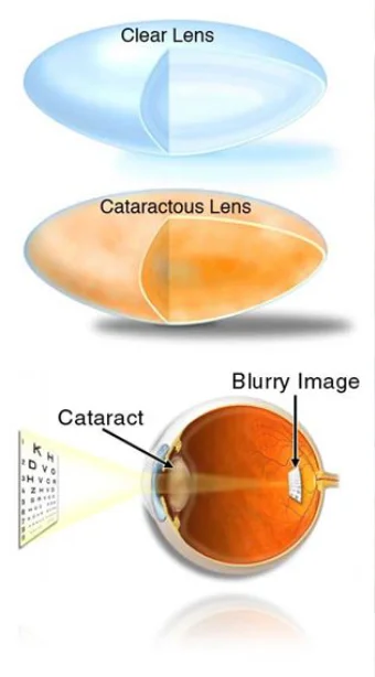 Cataract Surgery Brisbane Dr Brendan Cronin